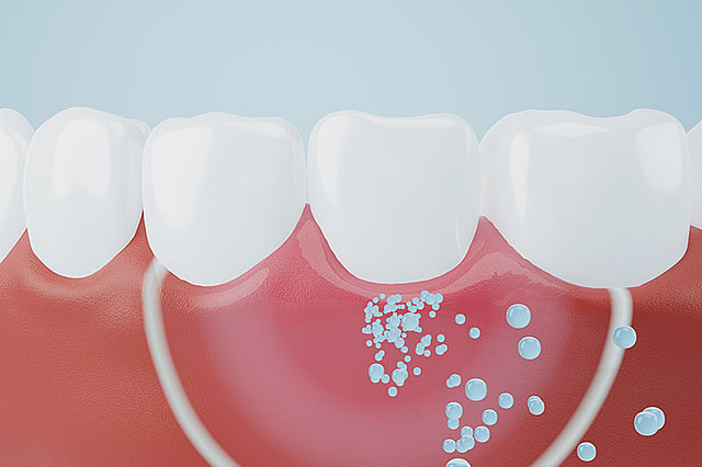 ガムピーリング