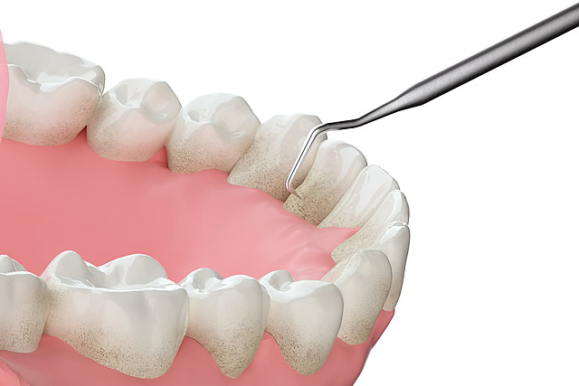 歯のクリーニング